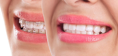 Napa Dental | Orthodontics, Dental Bridges and Implant Dentistry