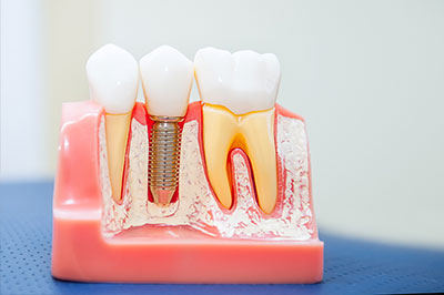 Napa Dental | Extractions, Oral Exams and Root Canals