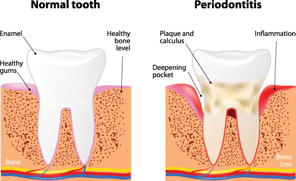 Napa Dental | Crowns  amp  Caps, Oral Exams and Orthodontics