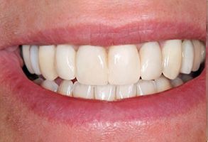 Napa Dental | Teeth Whitening, Crowns  amp  Caps and Orthodontics