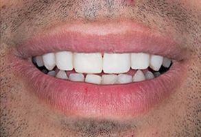 Napa Dental | Dentures, Oral Exams and Dental Sealants