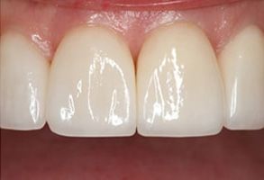 Napa Dental | Crowns  amp  Caps, Dental Cleanings and Orthodontics