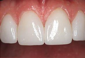 Napa Dental | Veneers, Root Canals and Teeth Whitening
