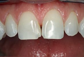 Napa Dental | Cosmetic Dentistry, Teeth Whitening and Dental Fillings